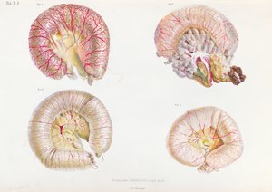 The external surface of the intestines infected with cholera, from Anatomie Pathologique du Cholera Morbus, by Nikolai Ivanovich Pirogov published in St. Petersburg, 1849 by Russian School