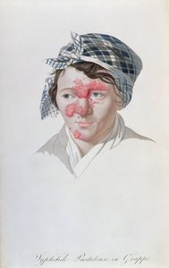 Syphilic Cluster Pustules, from a Book by Baron Jean Louis Alibert, 1838 by Salvadore Tresca