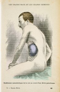 Typical Enlarged Spleen of a Malaria Patient by Unbekannt