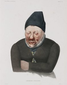 Diseases, Leprosy
