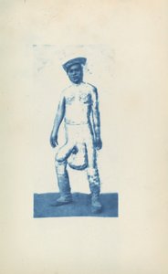 Elephantiasis by Unknown 19th Century