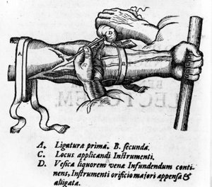 Anatomical board: different ligatures. Work on the blood system by William Harvey (1578-1657), English doctor. He described the circulation of blood in the body through the veins