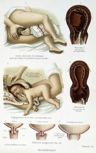 Childbirth - scientific board, late 19th century by Unknown artist