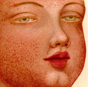 Eruptive Fevers: Scarlatina or Scarlet Fever