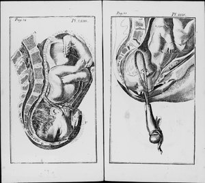 Birth of a Baby with Use of Forceps by Unknown artist