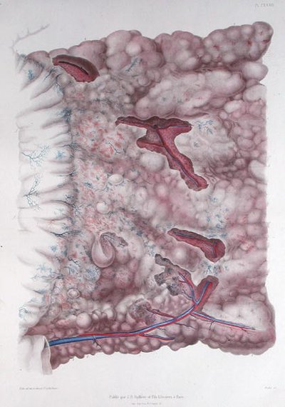 Cancer of the Epiploon, from 