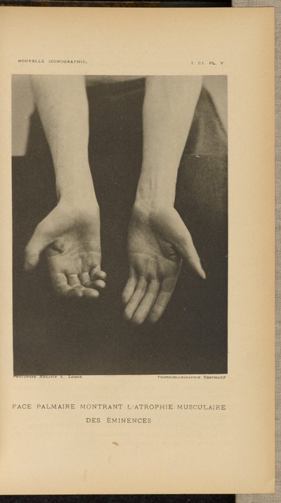 Palmar Face Showing Muscular Atrophy of the Eminences by Albert Londe