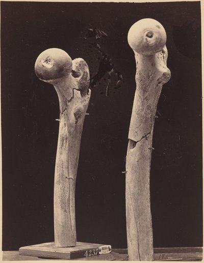 Specimens of Gunshot Fractures of the Femur, c. 1867 by American Photographer