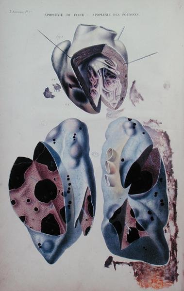 Apoplexy of the heart and of the lungs, illustration plate from Anatomie pathologique du corps humain by Jean Cruveilhier (1791-1874), published in Paris by Antoine Chazal