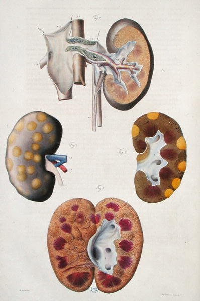 Diseases of the kidneys, from 