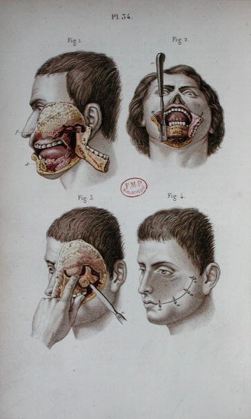 Anatomical plate of the upper jaw by C and Huette E. Bernard