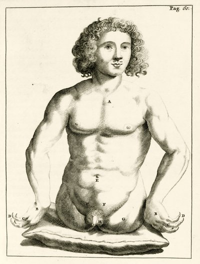 Example of congenital birth defects, from Exercitationes Practicae circa Medendi Methodum by Frederik Dekkers, 1694 by Dutch School