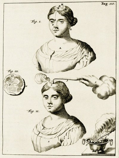 Treating a sufferer of Epilepsy, from Exercitationes Practicae circa Medendi Methodum by Frederik Dekkers, 1694 by Dutch School