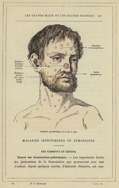 Characteristic Accidents of Acute Glanders by French School