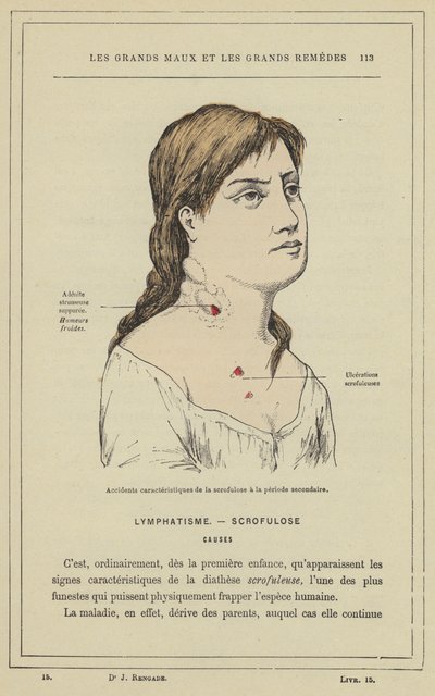 Characteristic accidents of scrofula in the secondary period by French School