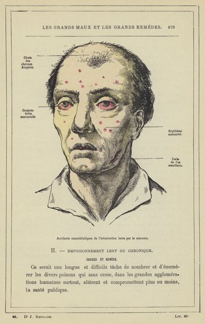 Characteristic Accidents of Slow Mercury Poisoning by French School