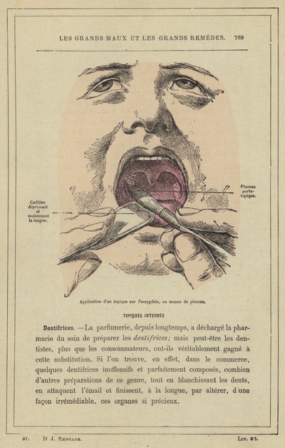 Application of a Topical Agent on the Tonsil, Using a Brush by French School