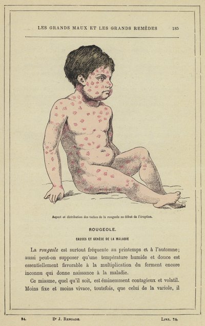 Aspect and Distribution of Measles Spots at the Beginning of the Eruption by French School