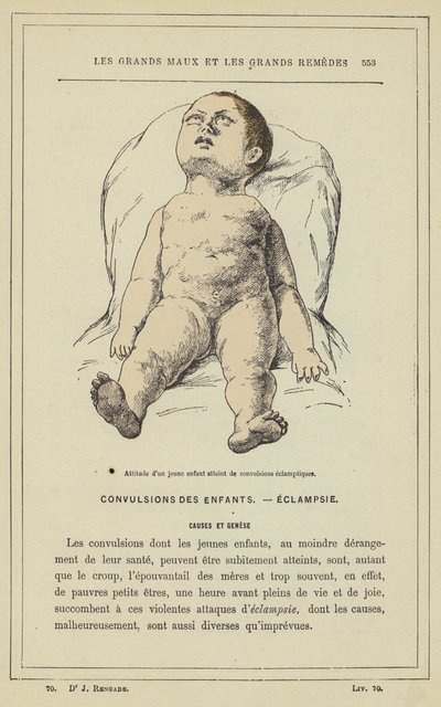 Attitude of a Young Child Suffering from Eclamptic Convulsions by French School