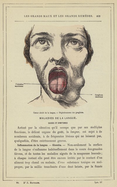 Ulcerated Cancer of the Tongue, Degeneration of the Glands by French School