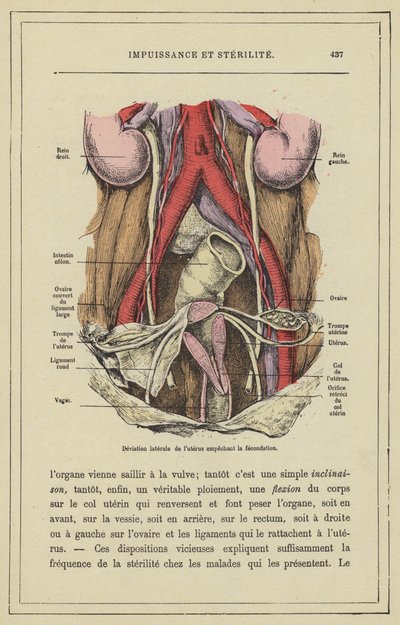 Lateral Deviation of the Uterus Preventing Fertilization by French School