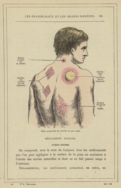 Comparative effects of the most common revulsives by French School