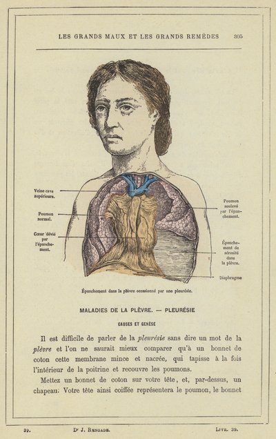 Pleural Effusion Caused by Pleurisy by French School