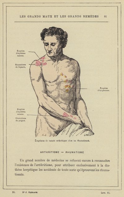 Arthritic Nature Eruptions in a Rheumatic Person by French School