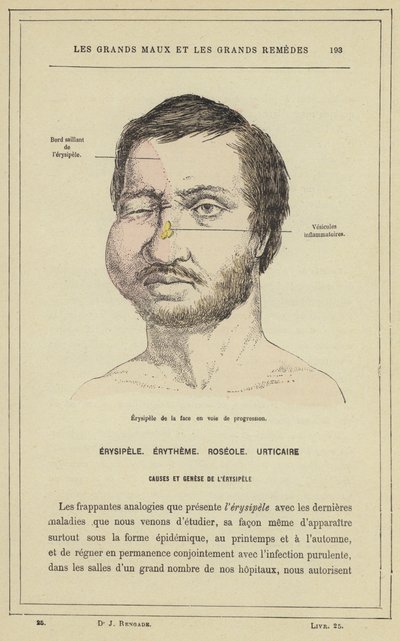 Progressing Facial Erysipelas by French School