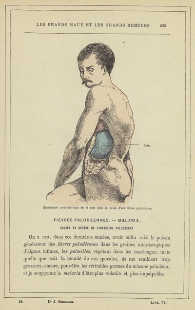 Characteristic Swelling of the Spleen During a Malarial Fever by French School