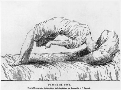 Hysteria and Somnambulism, from Les Maladies Epidemiques de l