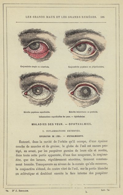 Superficial Eye Inflammations, Ophthalmies by French School