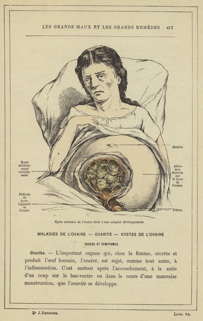 Areolar cyst of the right ovary at its complete development by French School