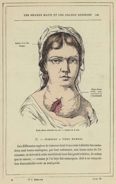 Partitioned Serous Cyst of the Neck, Head Lipoma by French School