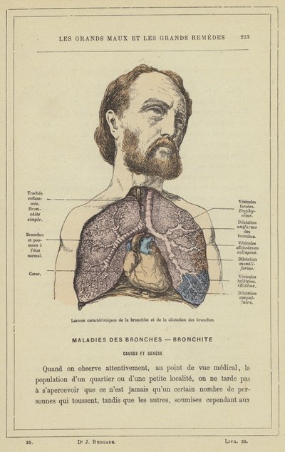 Characteristic Lesions of Bronchitis and Bronchial Dilation by French School