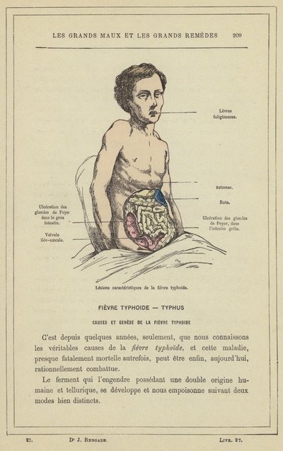 Characteristic Lesions of Typhoid Fever by French School