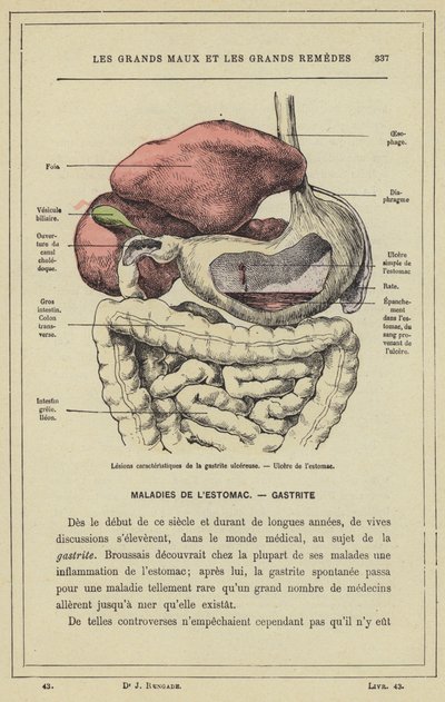 Characteristic Lesions of Ulcerative Gastritis, Stomach Ulcer by French School