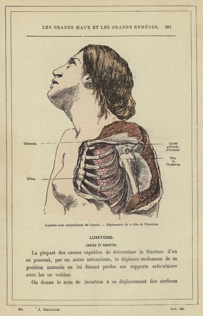 Subcoracoid dislocation of the shoulder, displacement of the head of the humerus by French School
