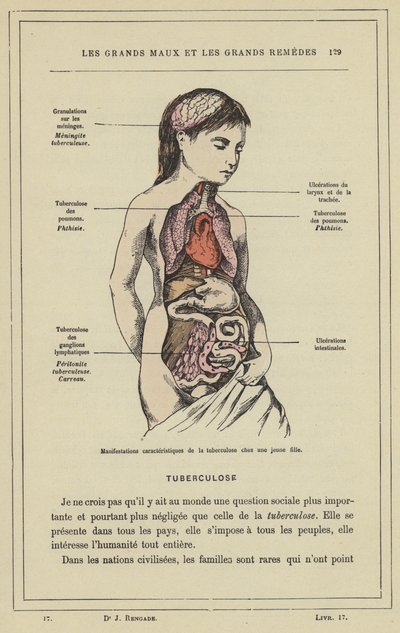 Characteristic Manifestations of Tuberculosis in a Young Girl by French School
