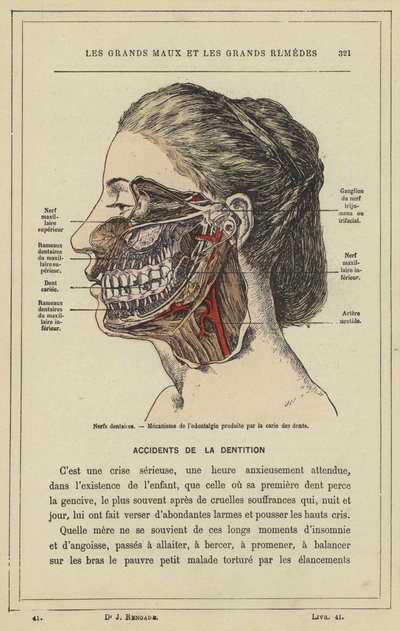 Dental Nerves, Mechanism of Toothache Caused by Tooth Decay by French School