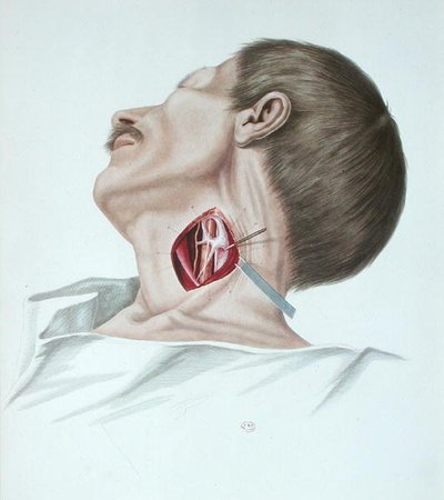 Operation on an aneurism, from 