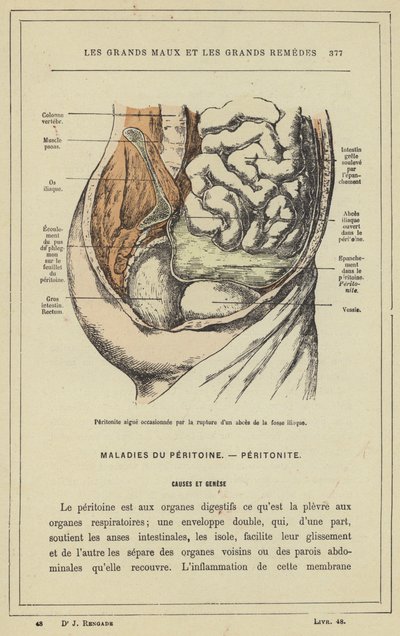 Acute Peritonitis Caused by the Rupture of an Iliac Fossa Abscess by French School