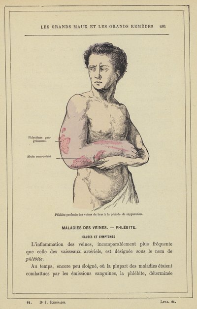 Deep Phlebitis of the Arm Veins at the Suppuration Stage by French School