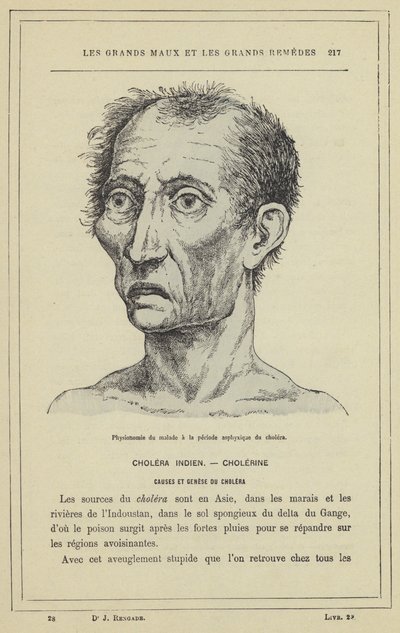 Appearance of the Patient in the Asphyxial Stage of Cholera by French School