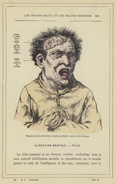 Physiognomy of an Insane Person with General Paralysis, in a Fit of Fury by French School