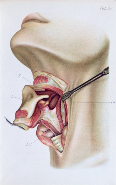 Plate from Atlas and Epitome of Operative Surgery by Dr. Otto Zuckerkandl, 1910 by French School
