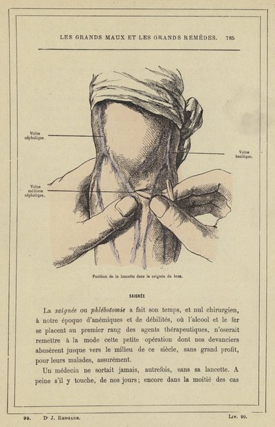 Position of the Lancet in Arm Bleeding by French School