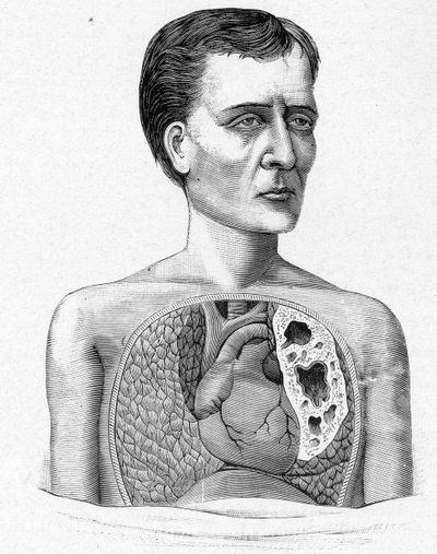 Representation of a person with caves, complication of tuberculosis by French School