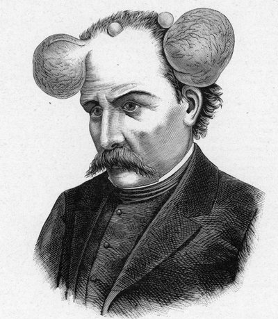 Representation of a person with magnifying glass, scalp cysts by French School