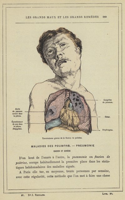 Severe Outcomes of Chest Fluxion by French School